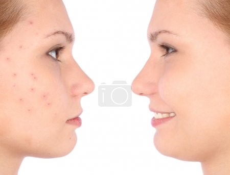 Glycolic acid vs Salicylic acid
difference between glycolic acid and salicylic acid
does glycolic acid help acne
glycolic acid side effects